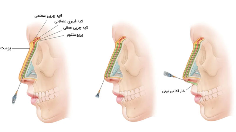 مراحل تزریق فیلر بینی