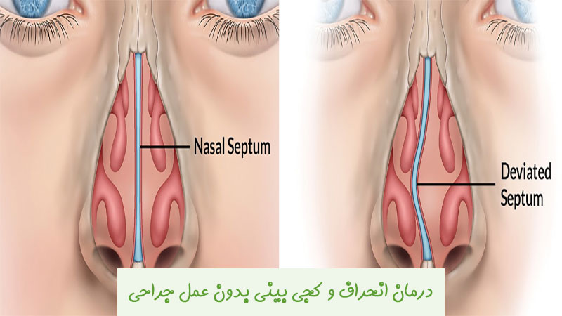 درمان انحراف و کجی بینی بدون عمل جراحی