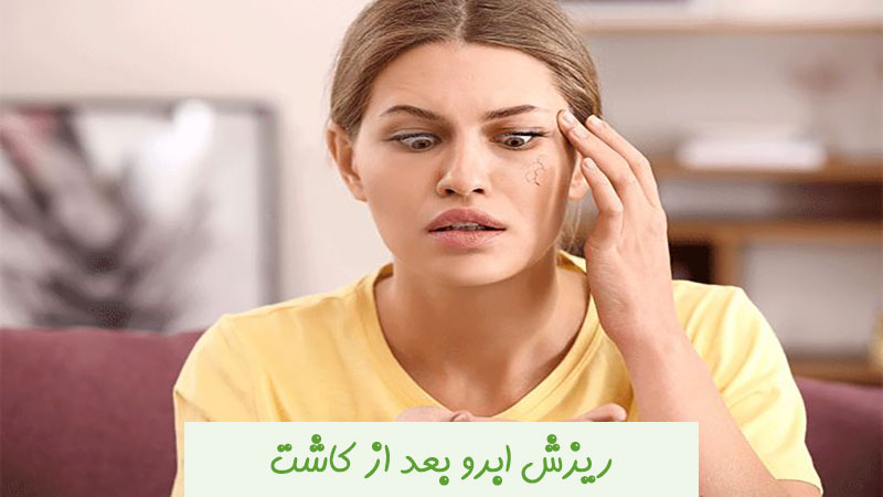 ریزش ابرو بعد از کاشت